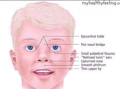 prader willi syndrome in children